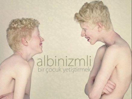 Albinizmli Bir Çocuk Yetiştirmek - Görsel 3